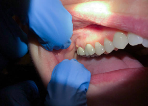 Best Emergency Wisdom Teeth Removal in Golden Gate, FL