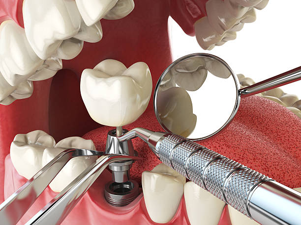 Best Emergency Tooth Extraction in Golden Gate, FL